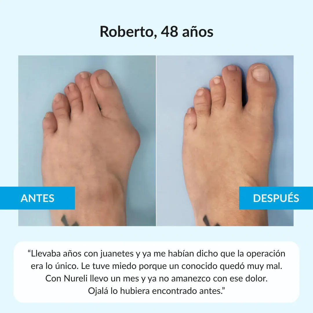 Nuleri™ - Corrector de Juanetes