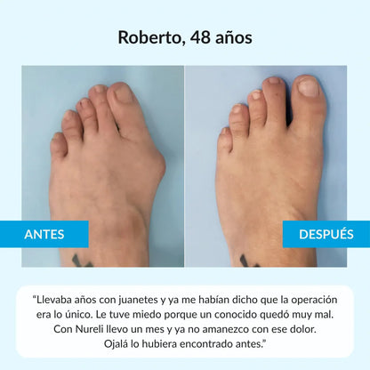 Nuleri™ - Corrector de Juanetes